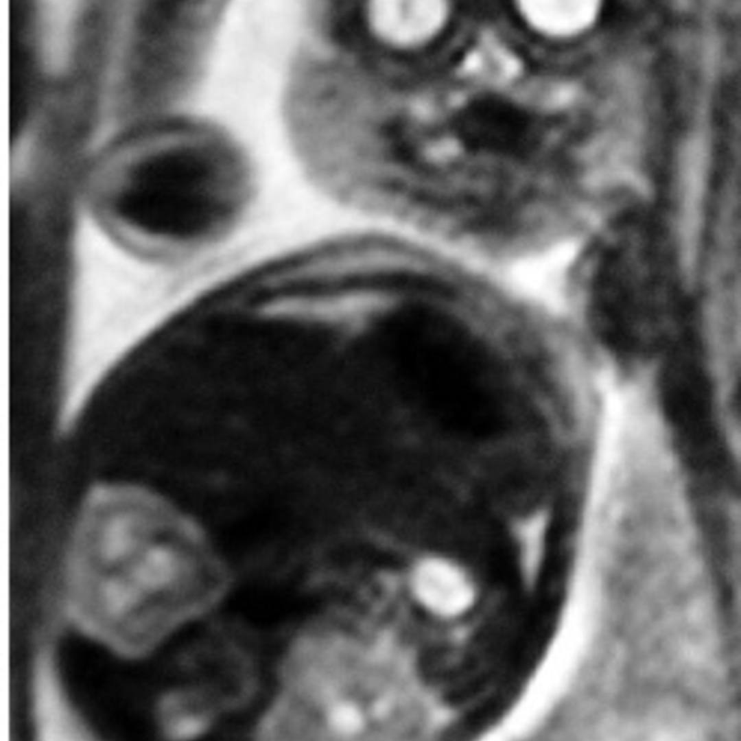 📃 MRI, Cleft lip/palate