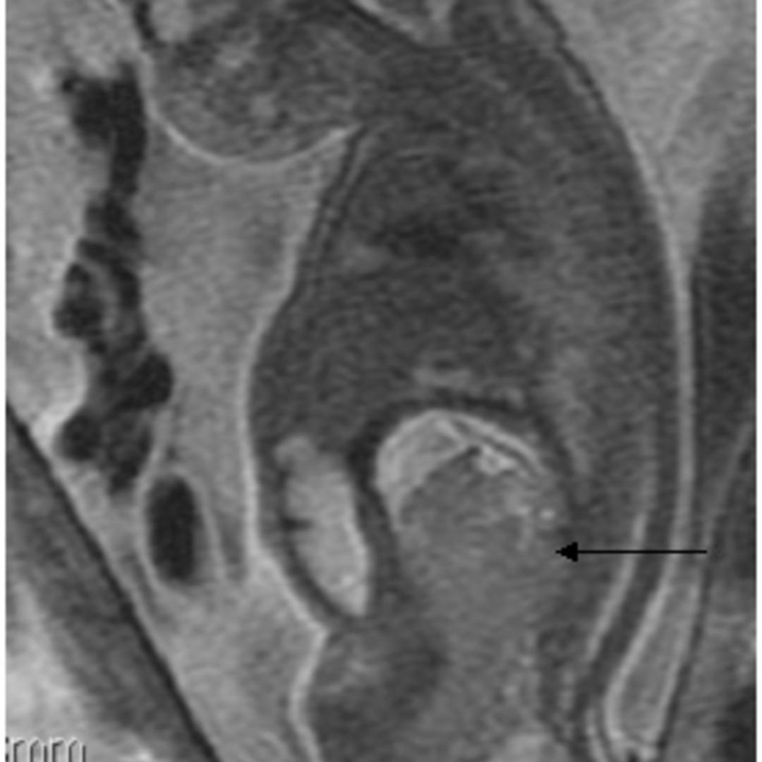 📃 Sacrococcygeal teratoma
