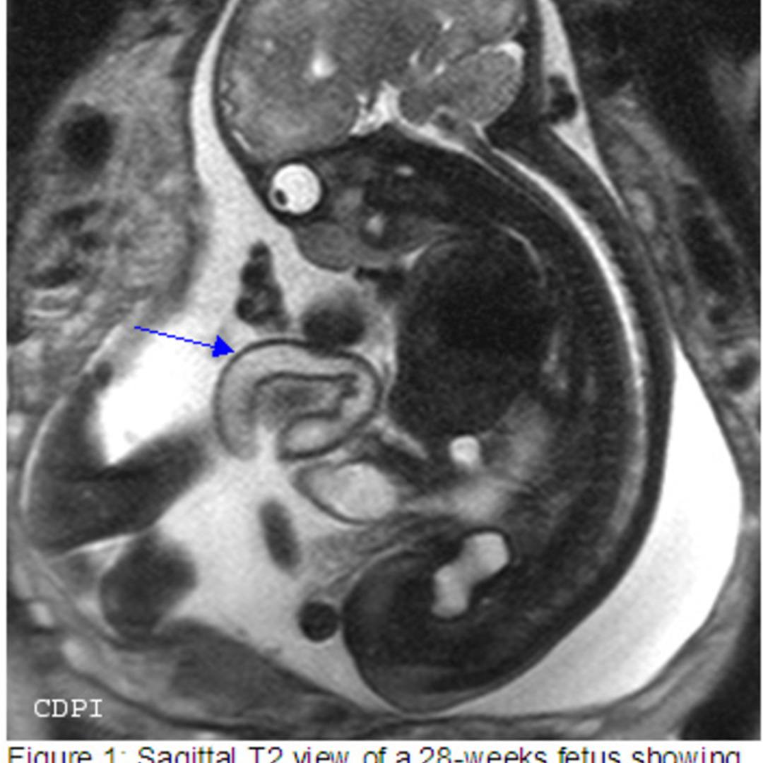 📃 MRI, Omphalocele, gastroschisis and Pentalogy of Cantrell