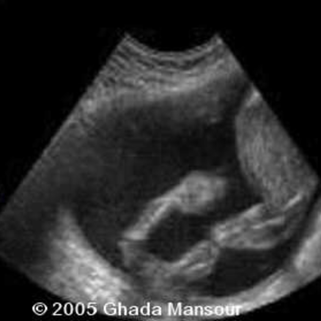 📃 Bilateral talipes equinovarus