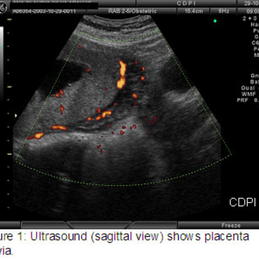 plasenta previa ultrasonu