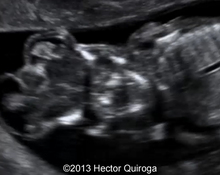 Amniotic band syndrome, ectopia cordis, 13 weeks image