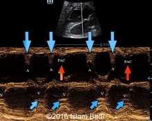 Blocked atrial trigeminy resulting in fetal bradyarrhytmias image