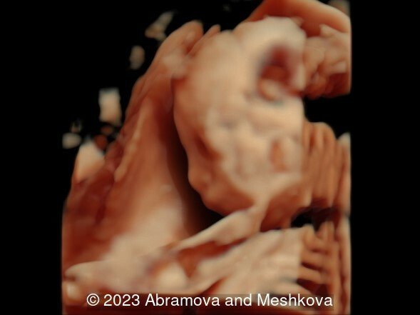 3D reconstruction of the fetal profile