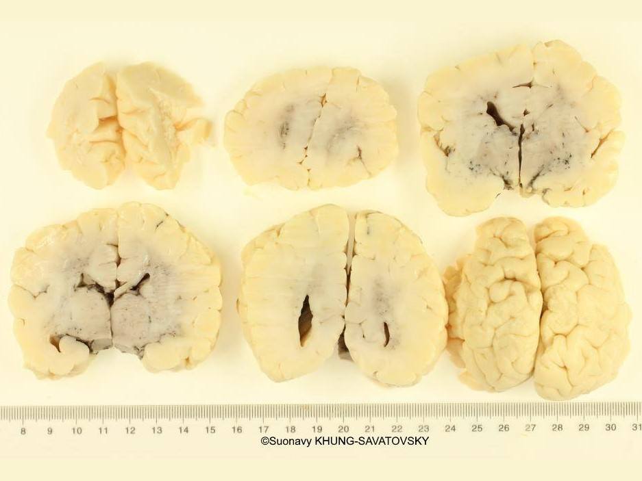 Distortion of the anterior part of the interhemispheric fissure.