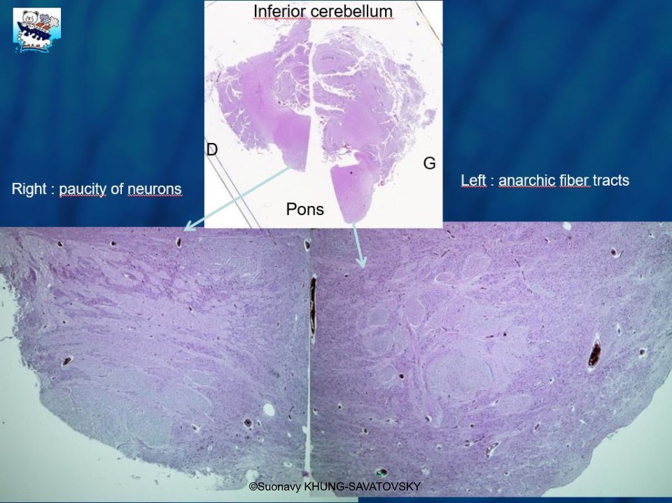 Pons showing a paucity of neurons on the right side, and anarchic fiber tracts on the left side.