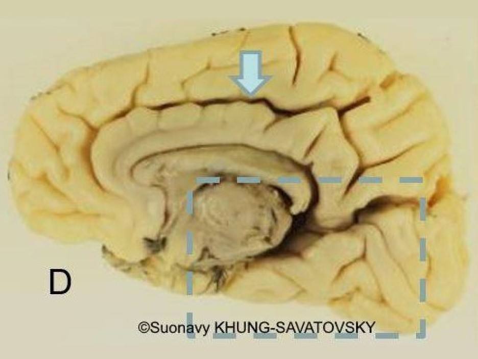 Inner right view showing an usual cingulate sulcus (arrow).