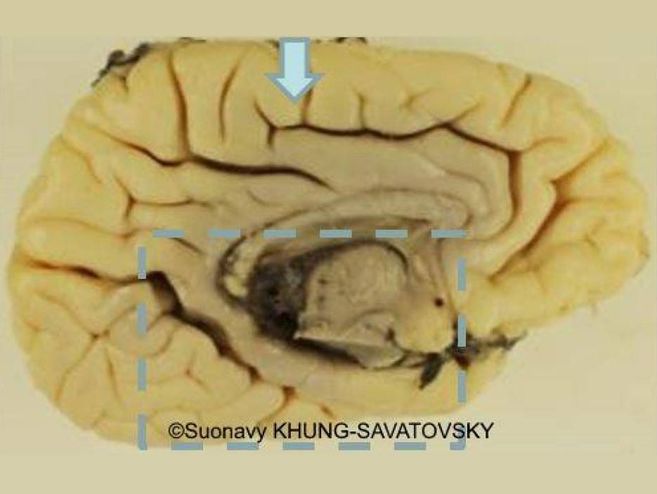 Inner left view showing an unusual interrupted cingulate sulcus (arrow).