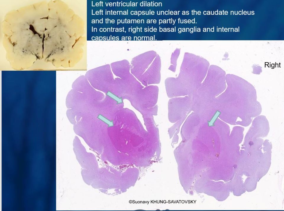 On the left side, the caudate nucleus and the putamen are partly fused by small "bridges" of grey matter interrupting the internal capsule white matter tract. This is suggestive of tubulinopathies.