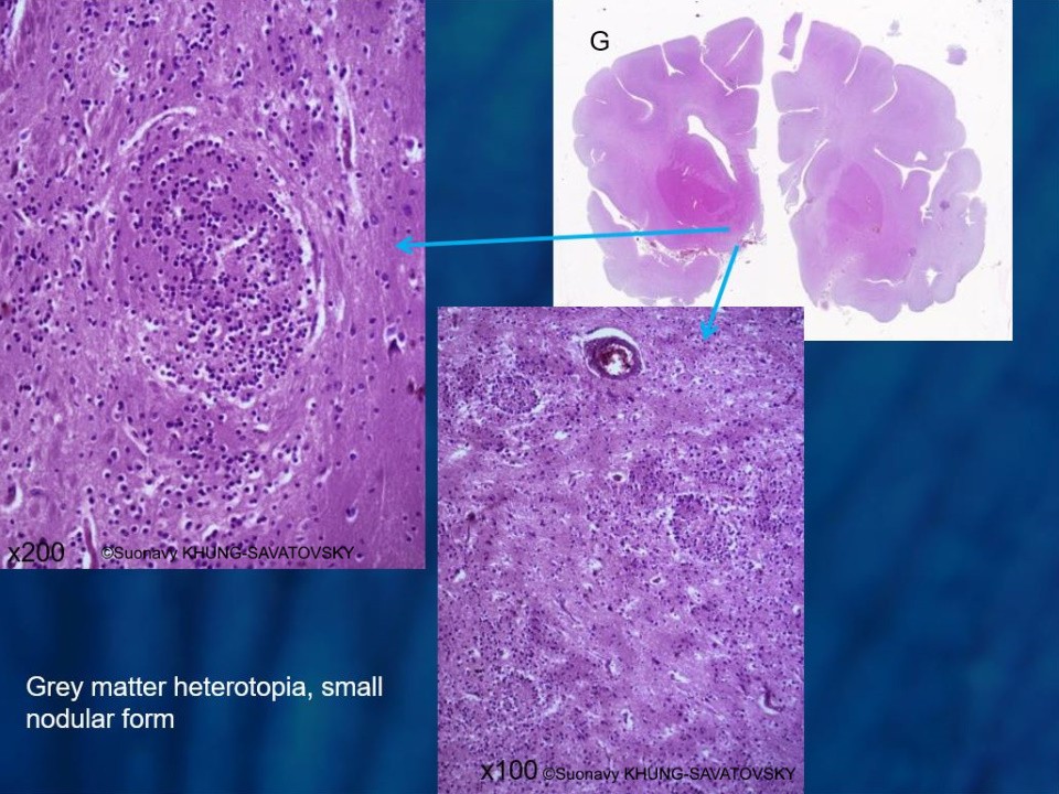 Non-specific grey matter heterotopia in nodular forms.