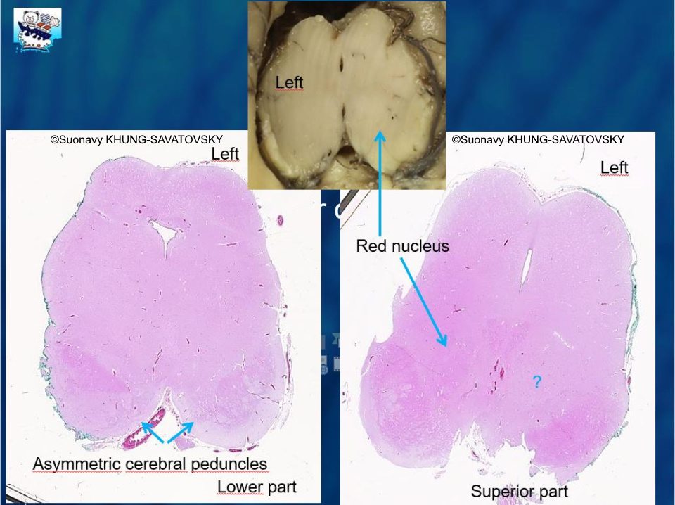 Asymmetric cerebral peduncles. Absence of red nucleus on the left side compared to the right side.