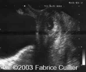 GC ECHOG ENDOVAGINALE 1