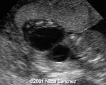 Amniotic band syndrome in a twin image