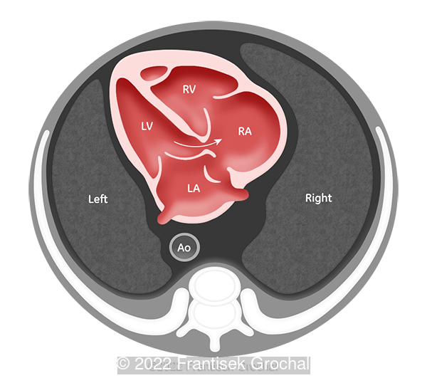 Gerbode defect type I - direct, supravalvular (arrow)