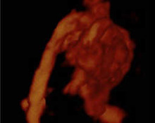 3D Fetal heart power-doppler image