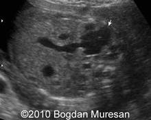 Hepatic mesenchymal hamartoma image