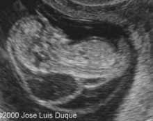 Cystic hygroma and allantoic cyst in a 1st trimester fetus image