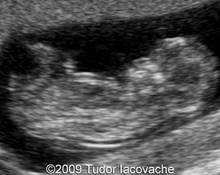 Holoprosencephaly, 12 weeks image