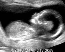 Semilobar holoprosencephaly, 14 weeks image