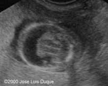 Alobar holoprosencephaly in a 1st trimester fetus image