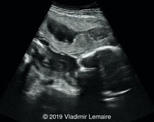 Placental Abruption with retroplacental hematoma image
