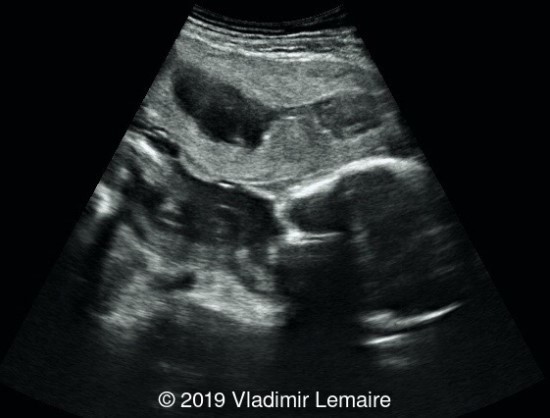 Image of an anterior placenta showing a hypoechoic hematoma between the placenta and the uterine wall.