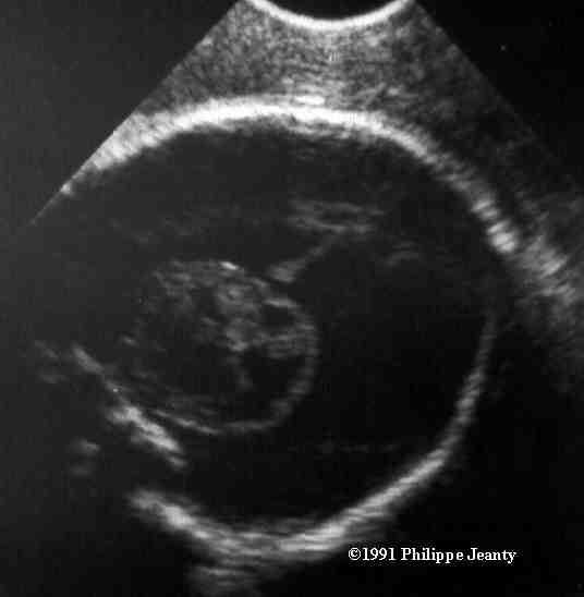 hydranencephaly ultrasound