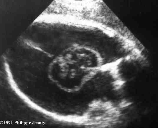 hydranencephaly ultrasound