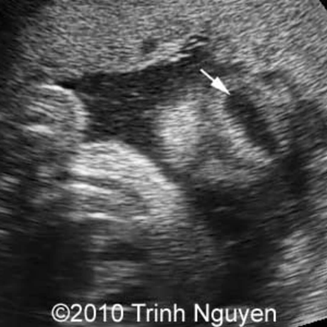 📃 Harlequin ichthyosis