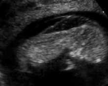 Increased nuchal lucency, video clip 1 image