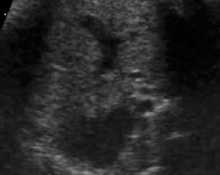 Persistent right umbilical vein, video clip image