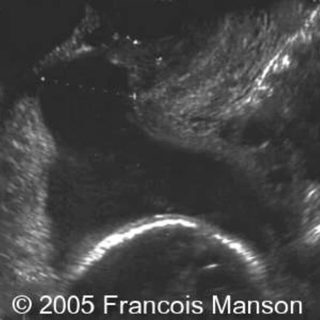 📃 Uterine dehiscence