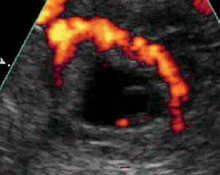 Ectopic pregnancy with decidual cast, video clip image