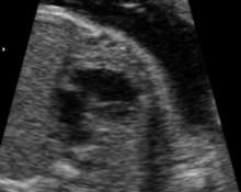 Hypoplastic left heart syndrome, 28 weeks image