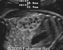 Echogenic kidneys, bilateral image