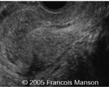 Ectopic pregnancy, tubal, live image