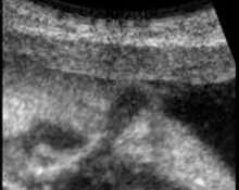 Meningocele and diastematomyelia image
