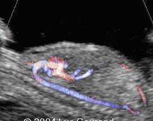 Ductus venosus Doppler in aneuploidy, score at 13 weeks image