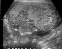 Molar pregnancy image