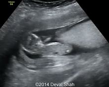 Partial molar pregnancy image