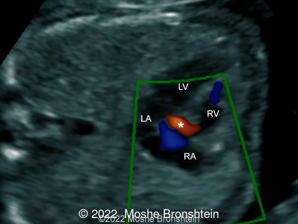 Gerbode defect (*) associated with ventricular septal defect and diagnosed at 15 weeks gestation