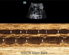 Multiple blocked premature atrial contractions resulting in fetal bradycardia image