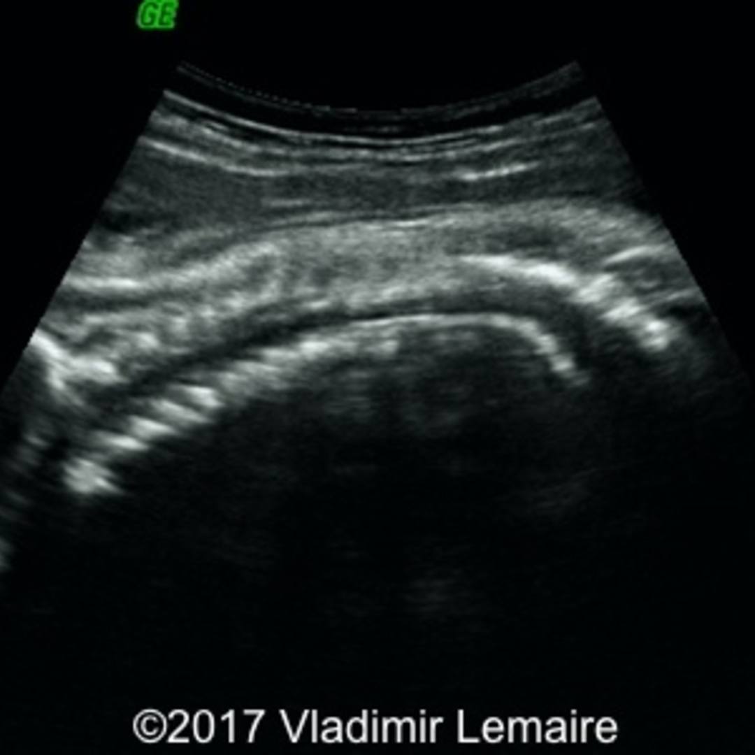 📃 Limb body wall complex