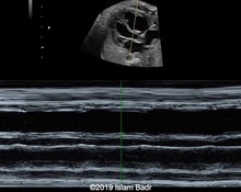 Atrioventricular reentrant tachycardia image