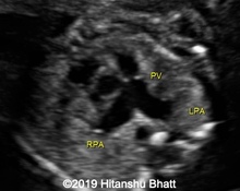 Absent pulmonary valve syndrome image