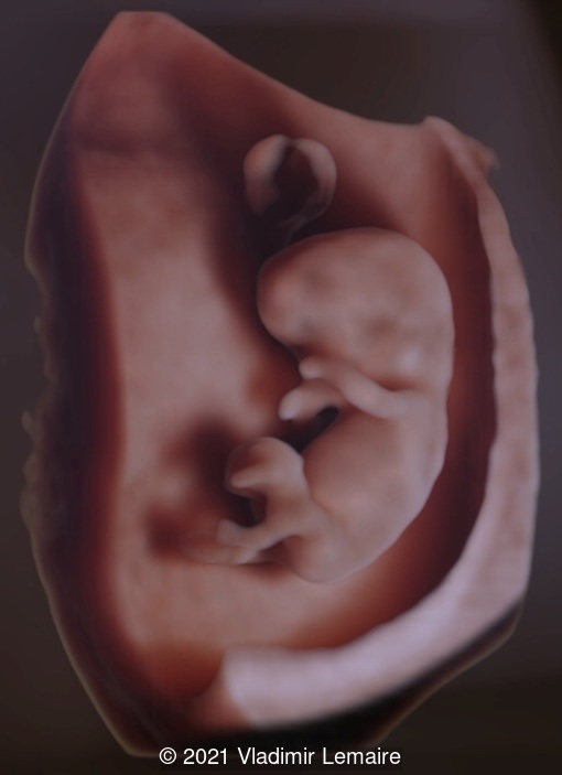 3D image of a normal embryo with a crown-rump length of 30.8 mm. Surface rendering with shadow highlights the outer surface of the embryo, umbilical cord and yolk sac. 