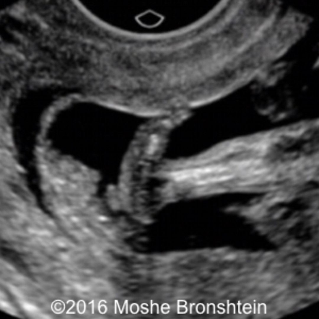 📃 Trisomy 9, rocker bottom foot