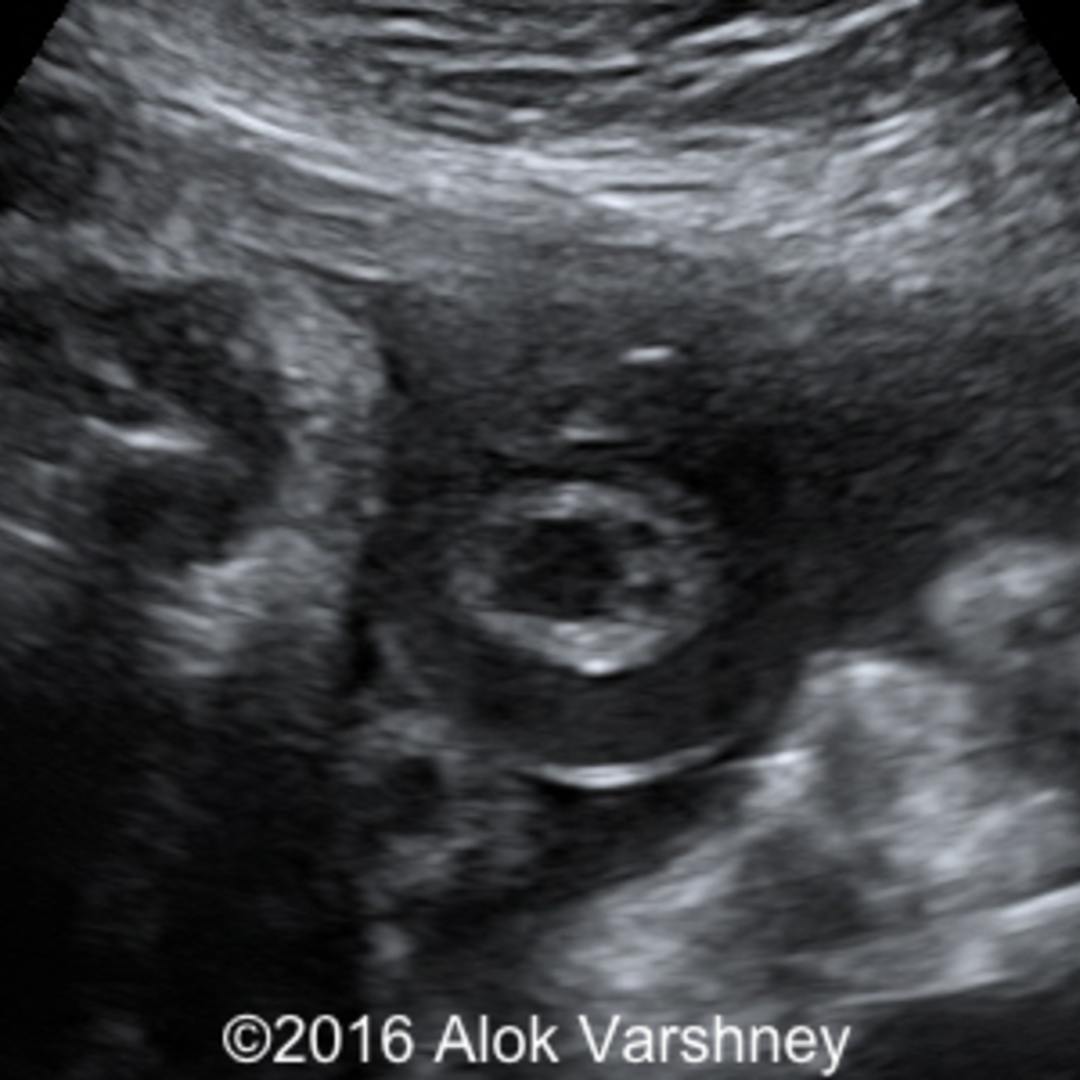  true knot of the umbilical cord knot