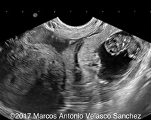 Tubal ectopic pregnancy image