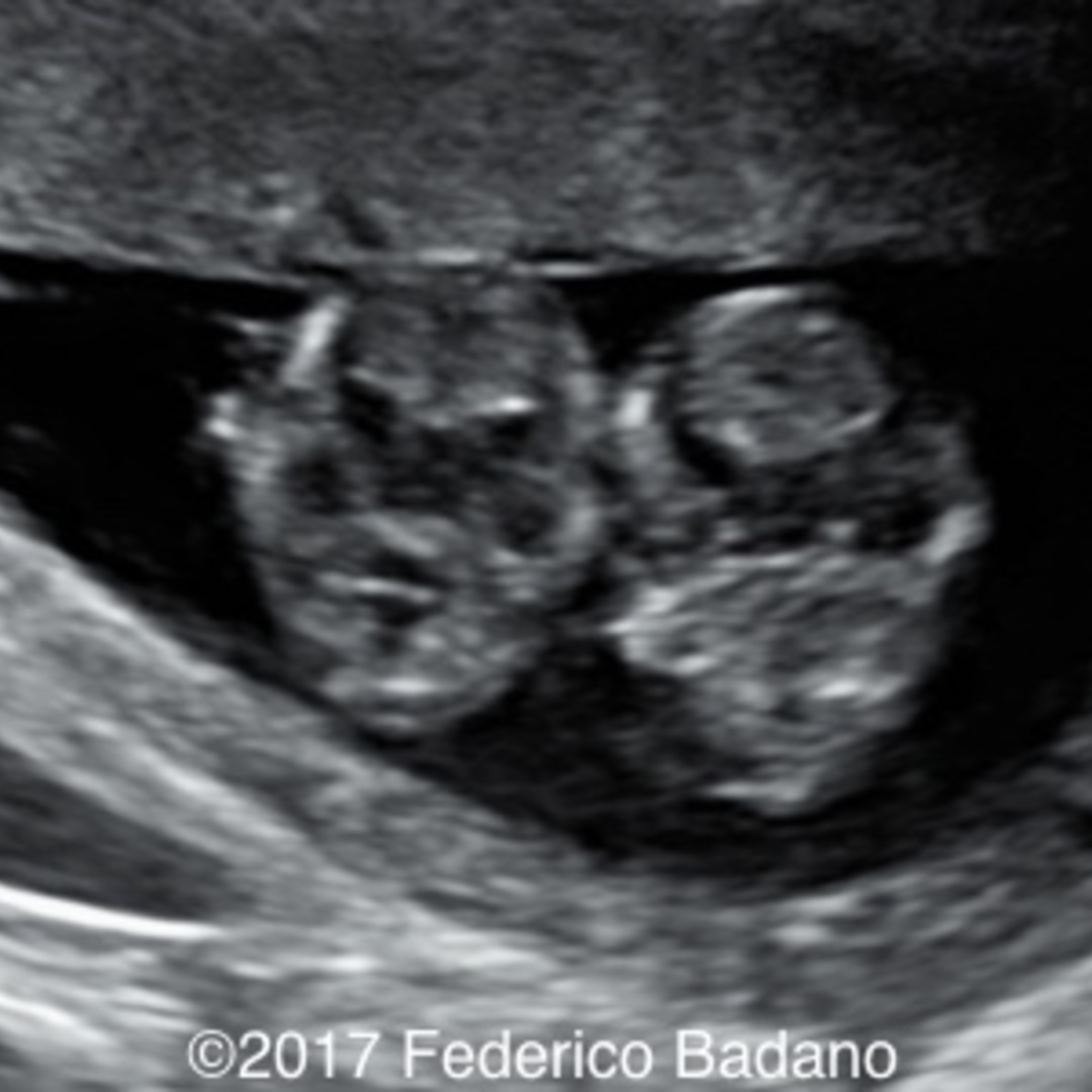 📃 Cord entanglement in monoamniotic twins